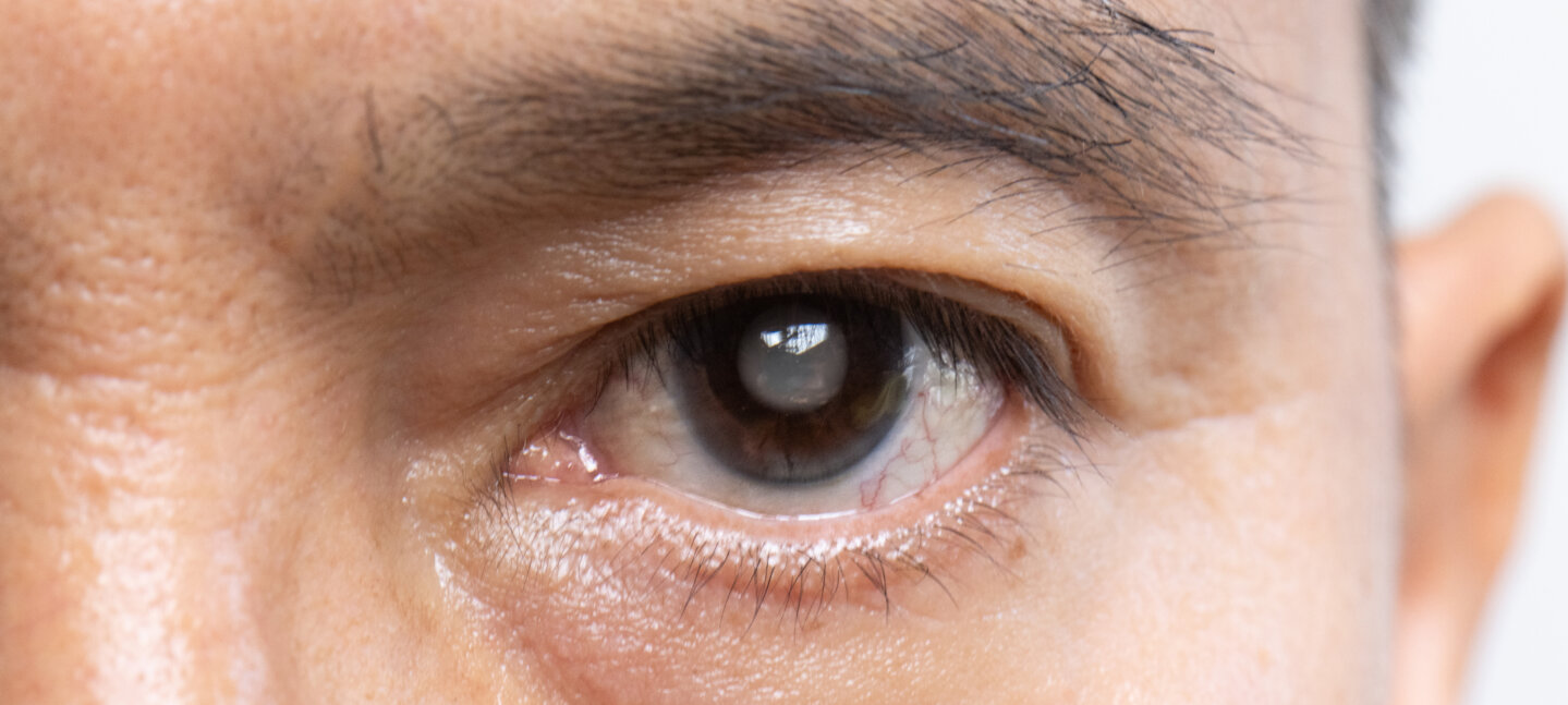 Tipos de Glaucoma y su Impacto en el Nervio Óptico