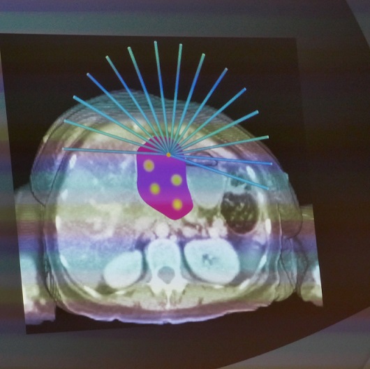La técnica LRT mejora la respuesta a la radioterapia de grandes tumores resistentes a tratamientos convencionales