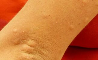 Intolerancias alimentarias