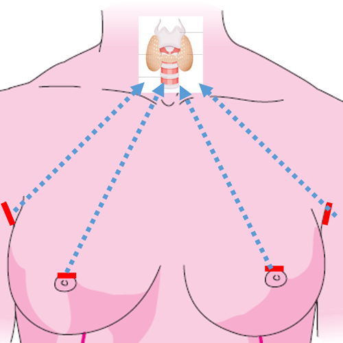 Un novedoso abordaje permite extirpar el tiroides sin dejar cicatriz en el cuello