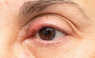 El 99% de los casos de cáncer de piel que afectan a los tejidos oculares tienen una curación definitiva