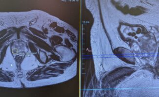 Vithas Madrid Aravaca incorpora la biopsia por fusión para el diagnóstico del cáncer de próstata