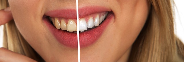 Desgaste dental: ¿sabes qué es y cómo se produce?