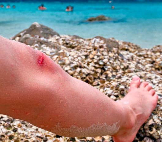 Cómo curar heridas que se producen en la playa