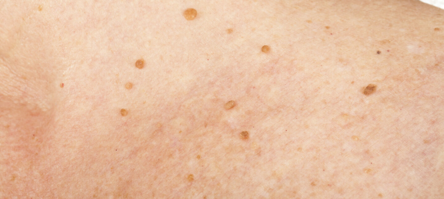 ¿Por qué es importante revisar lunares y manchas en nuestra piel?