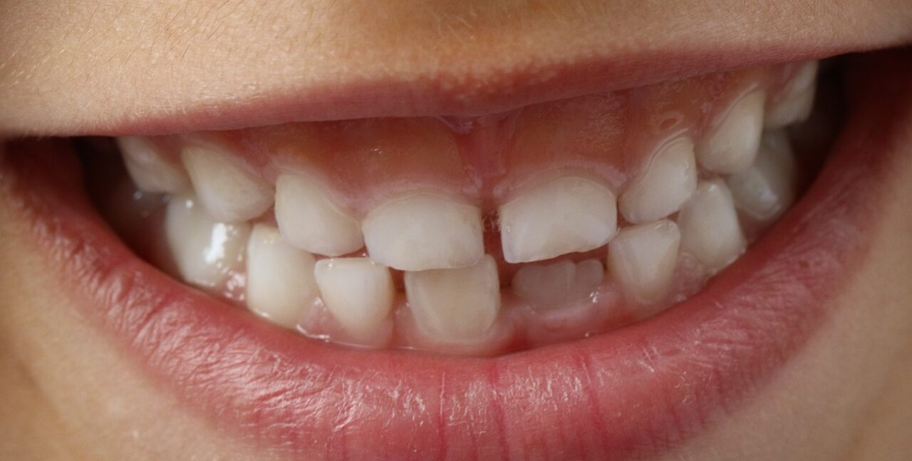 ¿Afecta la anquilosis dental a los niños?