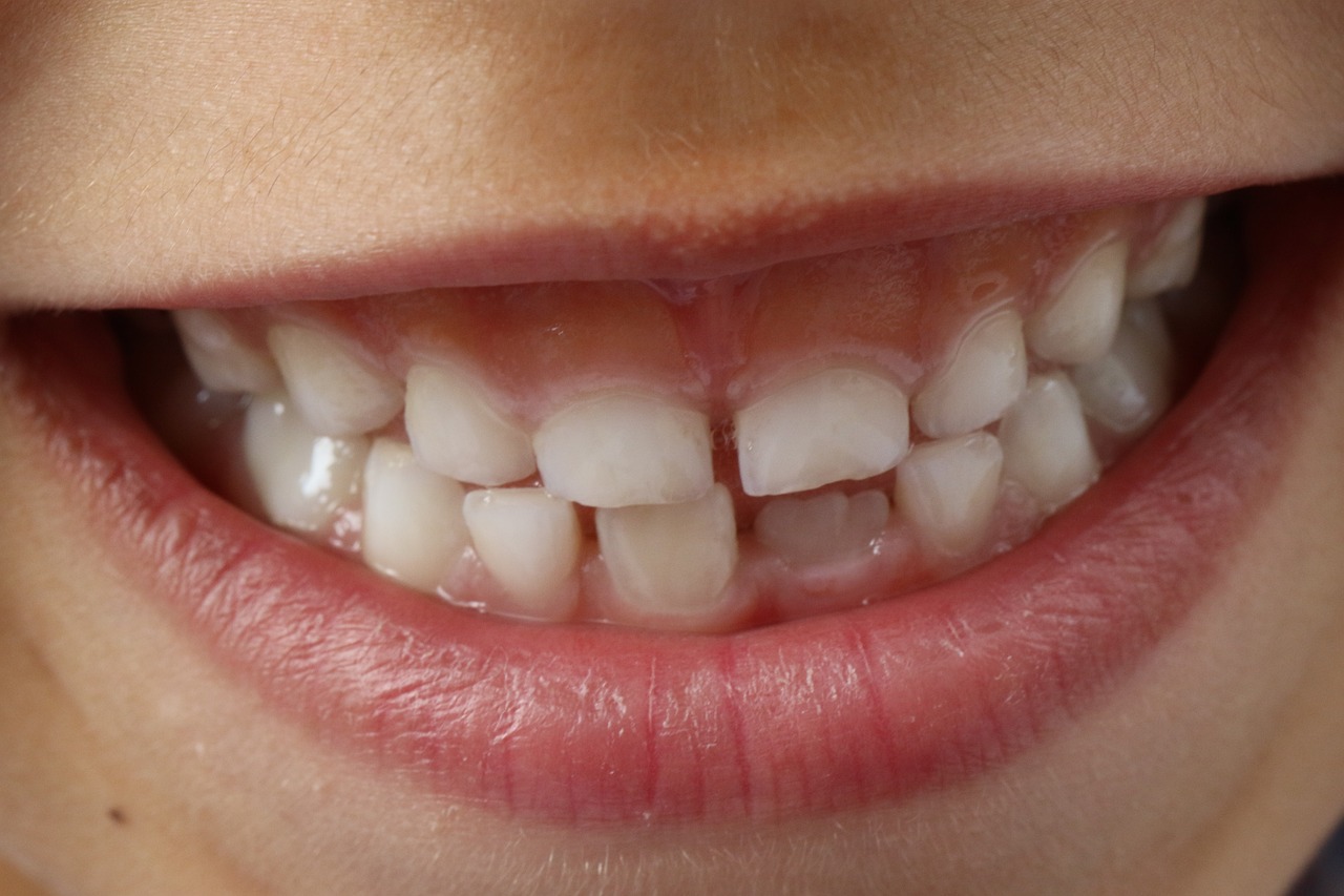 ¿Afecta la anquilosis dental a los niños? Vithas ¿Afecta la anquilosis dental a los niños? Vithas