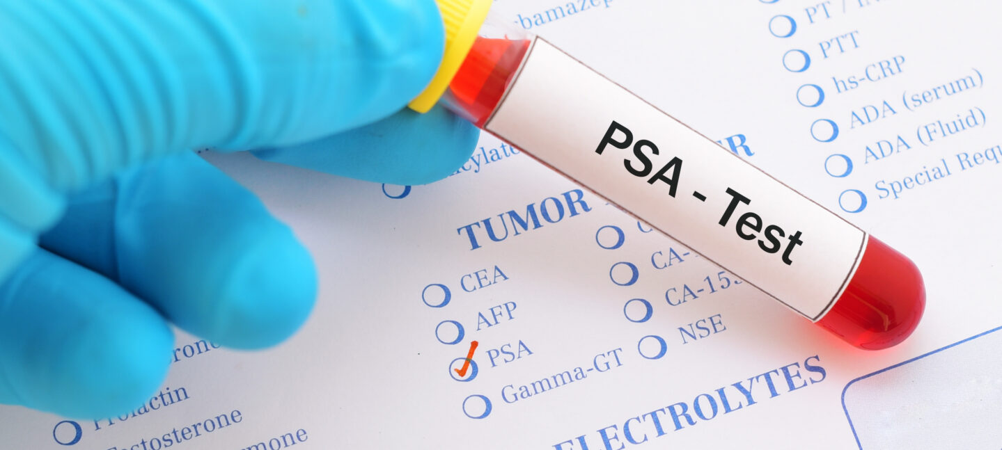 PSA en el Cáncer de Próstata: Guía Completa sobre el Antígeno Prostático Específico y su Importancia en la Detección