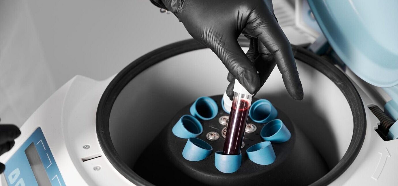 La biopsia líquida, una revolución en el diagnóstico y tratamiento del cáncer.