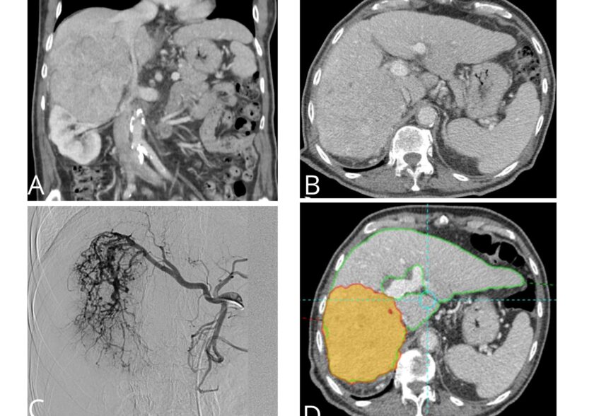 Radiología Intervencionista