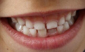 Una mala mordida puede afectar mucho más que tu sonrisa