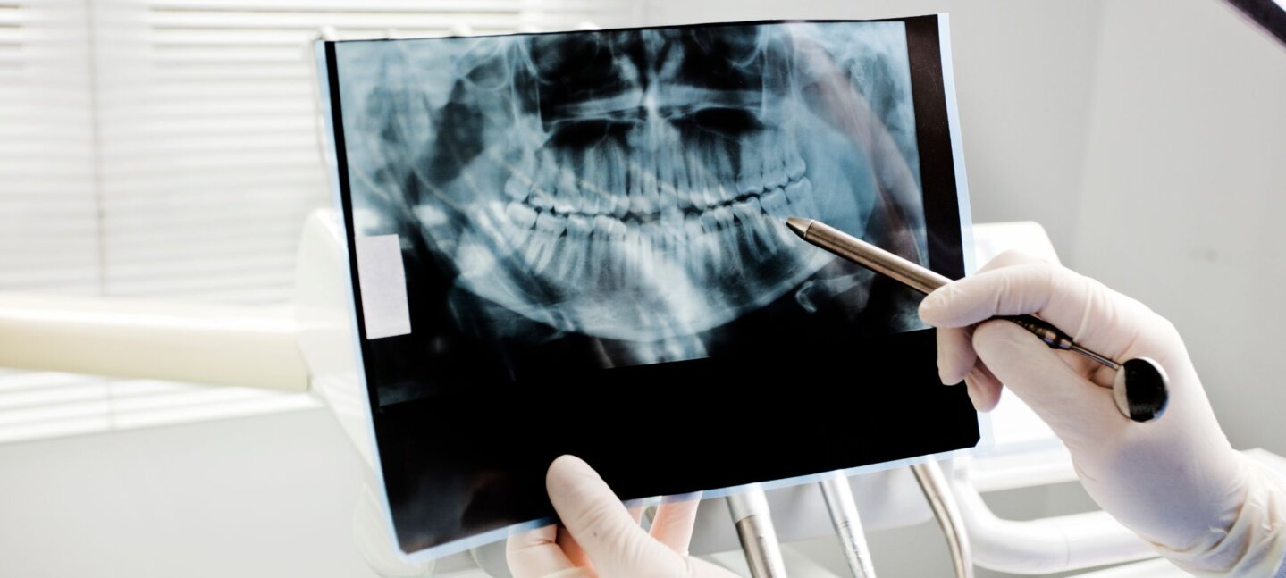 Cáncer oral: la importancia de la auto exploración