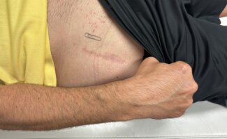 Vithas Valencia Turia refuerza su apuesta por la experiencia paciente e incorpora una técnica de vanguardia en cirugía de prótesis de cadera Vithas Valencia Turia refuerza su apuesta por la experiencia paciente e incorpora una técnica de vanguardia en cirugía de prótesis de cadera