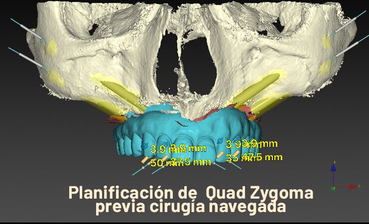 El Dr. Rubén Davó, del Hospital Vithas Medimar, lidera el primer estudio que avala el 'Quad Zygoma' como la solución definitiva para implantes maxilares fallidos