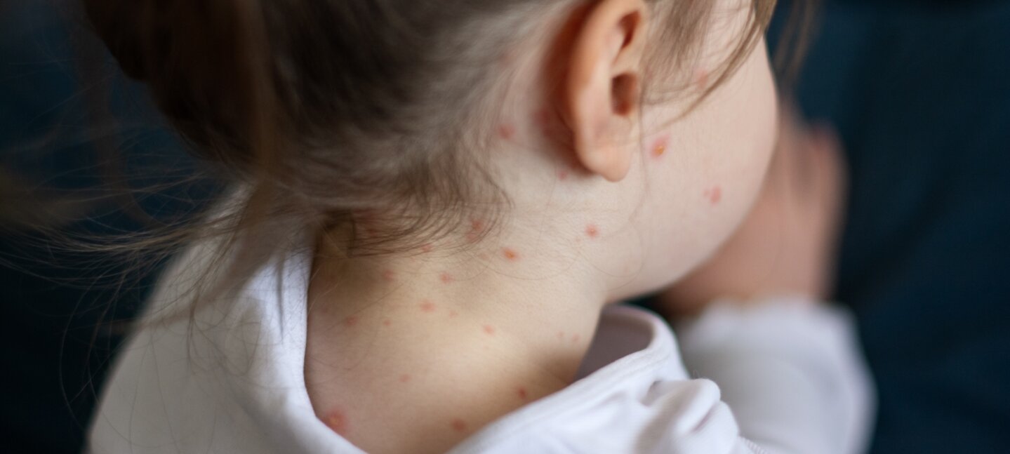 El sarampión puede contagiarse hasta cuatro días antes de mostrar síntomas visibles
