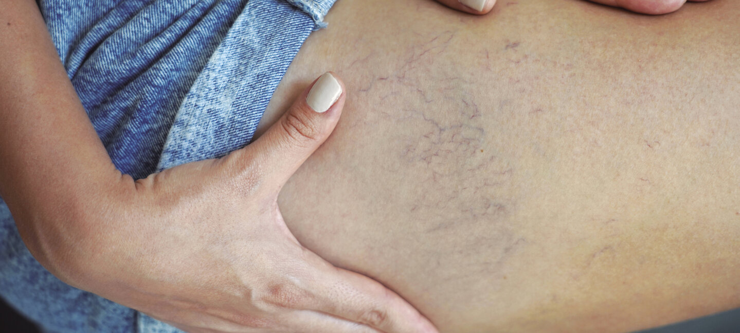 Especialistas de Vithas en la Comunidad Valenciana alertan del aumento de patologías venosas y recuerdan que no son solo un problema estético