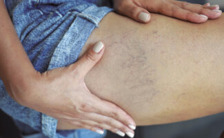 Especialistas de Vithas en la Comunidad Valenciana alertan del aumento de patologías venosas y recuerdan que no son solo un problema estético