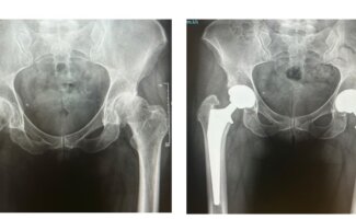 Radiografías de ambas caderas que muestran el antes y el después de una cirugía protésica bilateral por vía anterior
