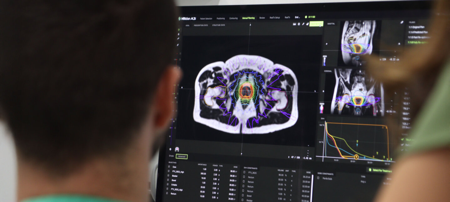 Oncología Radioterápica de Vithas Madrid La Milagrosa muestra la eficacia de la radioterapia adaptativa en el cáncer de próstata Oncología Radioterápica de Vithas Madrid La Milagrosa muestra la eficacia de la radioterapia adaptativa en el cáncer de próstata