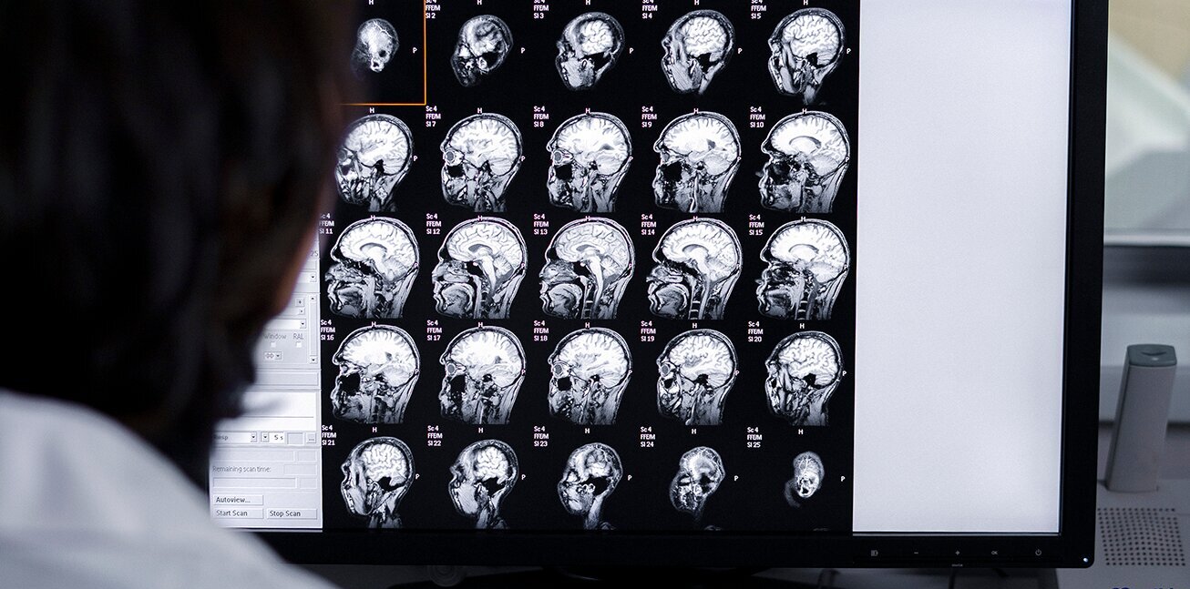 Vithas Vigo se convierte en el primer hospital gallego en tratar a pacientes de alzhéimer en fase leve con terapias antiamiloide Vithas Vigo se convierte en el primer hospital gallego en tratar a pacientes de alzhéimer en fase leve con terapias antiamiloide