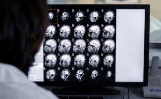 Vithas Vigo se convierte en el primer hospital gallego en tratar a pacientes de alzhéimer en fase leve con terapias antiamiloide Vithas Vigo se convierte en el primer hospital gallego en tratar a pacientes de alzhéimer en fase leve con terapias antiamiloide