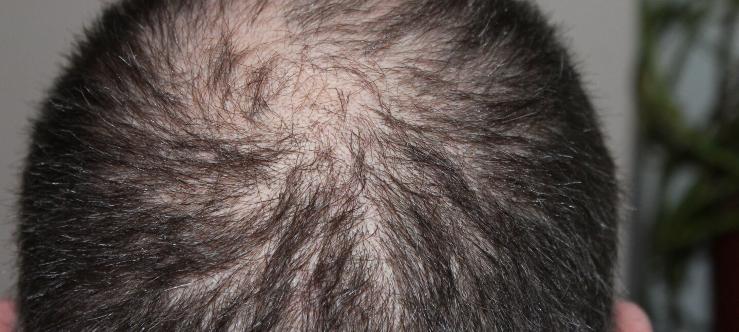 Caída del pelo: causas más frecuentes, cuándo preocuparse y cómo prevenirla Caída del pelo: causas más frecuentes, cuándo preocuparse y cómo prevenirla