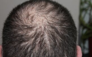 Caída del pelo: causas más frecuentes, cuándo preocuparse y cómo prevenirla